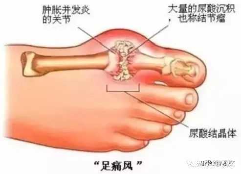 痛风为何从脚起