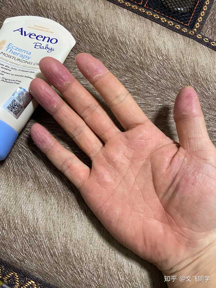 季节性手脱皮,什么原因?有什么方法可以根治吗?