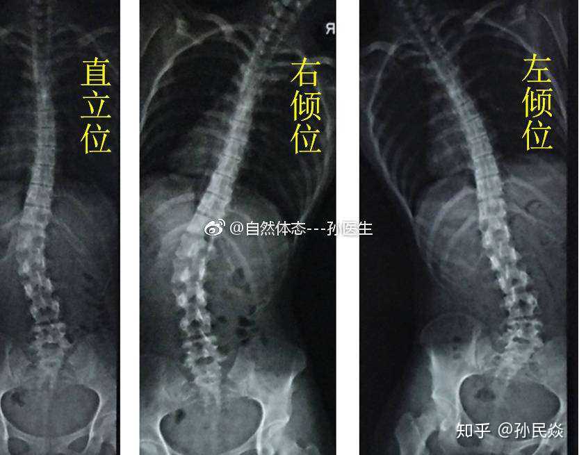 功能性与结构性同时存在的成人胸腰段脊柱侧弯.