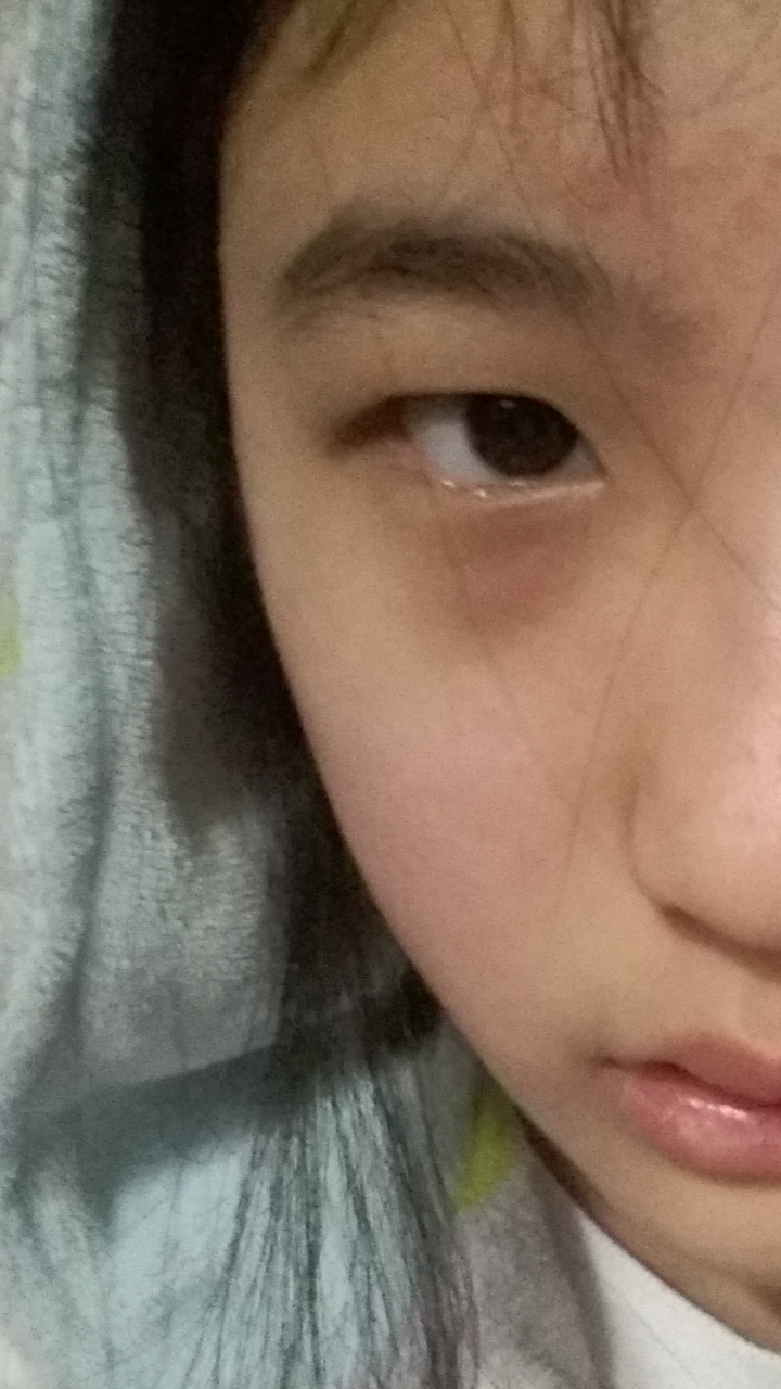 一只眼睛大一只眼睛小是怎么一种体验?