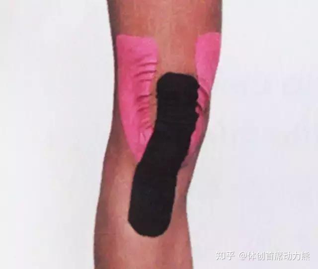 跑步后膝盖下面疼,膑腱炎可能,我该怎么办呢?