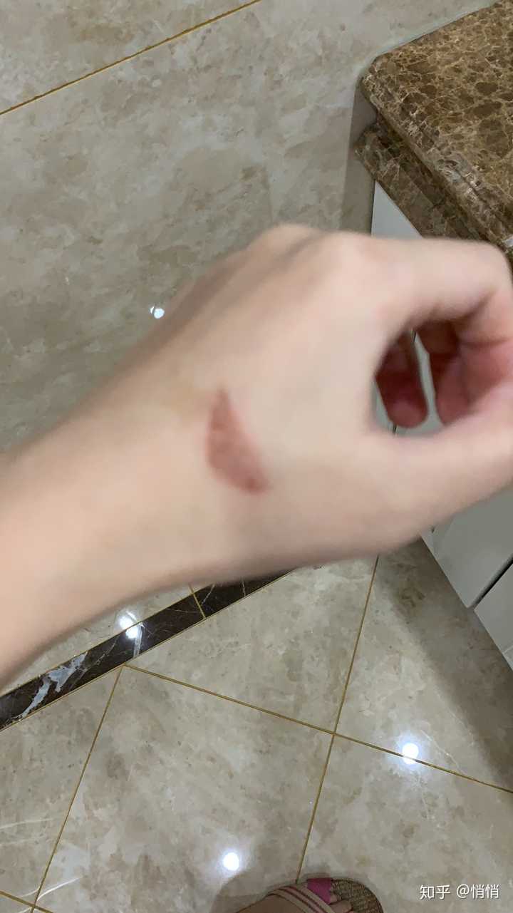 用烤箱的时候手被烫伤了会不会留疤啊?