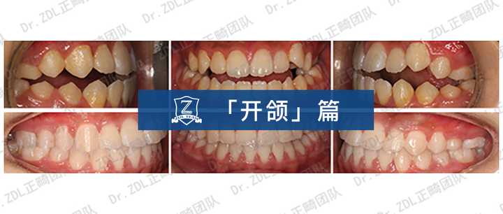 张栋梁正畸团队:牙齿开颌案例分享zhuanlan.zhihu.com文章