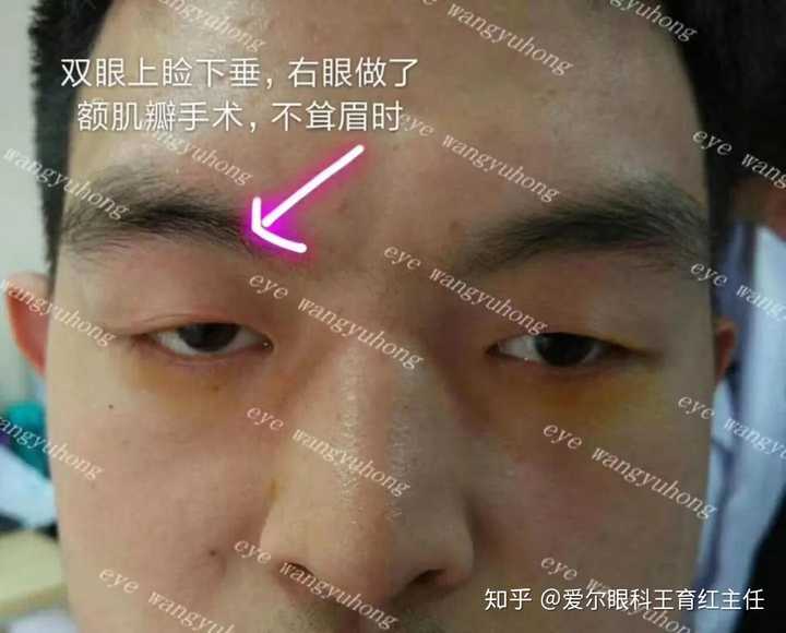 肿眼泡太严重该如何改善?