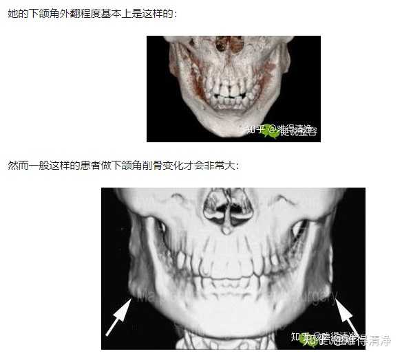 第二张图才是国字脸 典型的下颌角外翻.