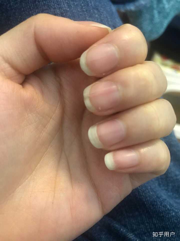 我的指甲也是乳白色,据说是缺钙.