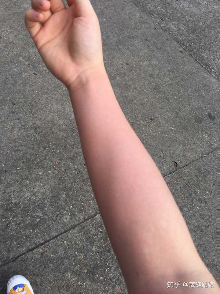 酒精过敏的人喝多了会怎么样?
