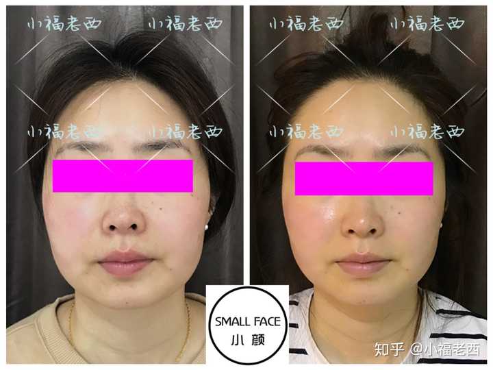 颧骨高,鼻子大,咬肌肥大,下颌宽,怎么办?哭t_t?