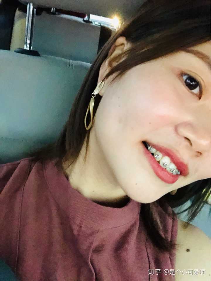 带牙套的女生很难看吗?