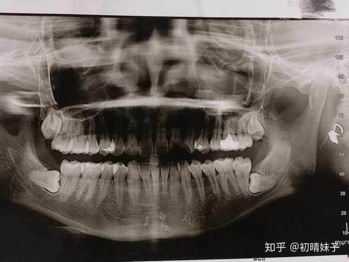 有小伙伴说想看我的牙片,就更新一下吧.