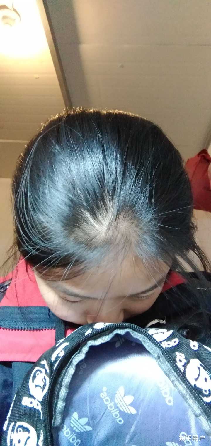 我真是枯辽… 以前没感觉到头发秃的问题,后来到高中就开始在意了
