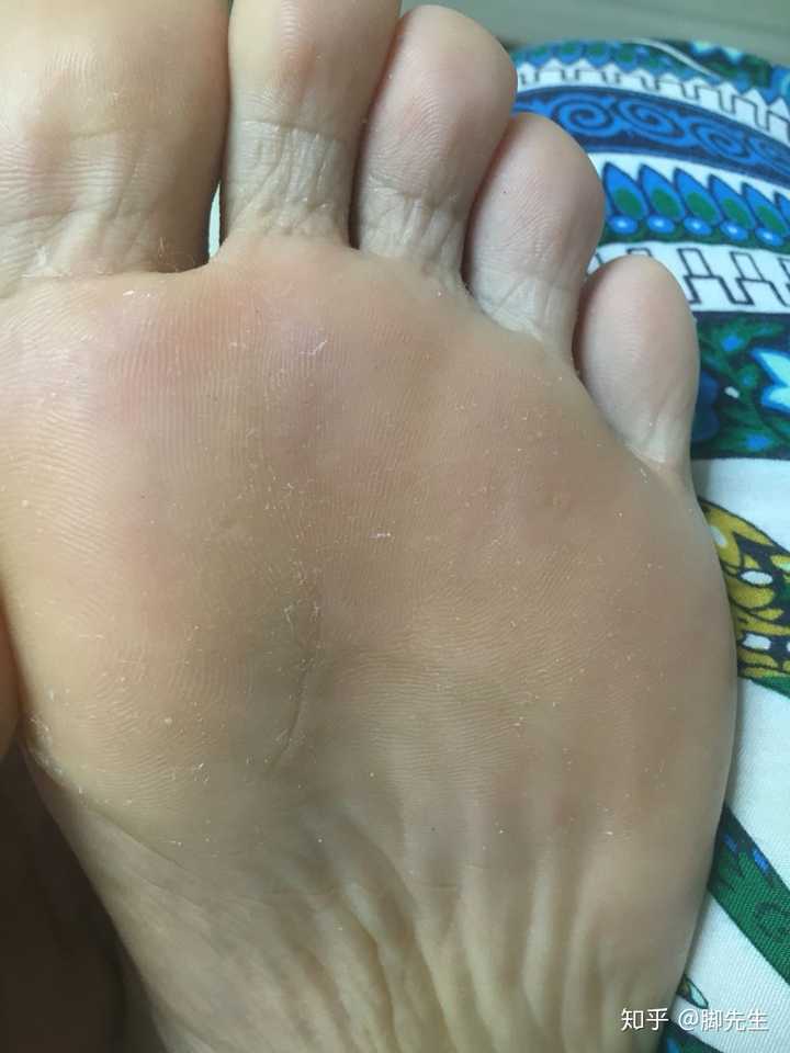 刚长出来的小跖疣怎么治?