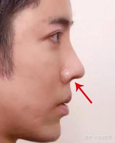 这种情况通常是采用 植入软骨,下拉鼻小柱的方法来调整.