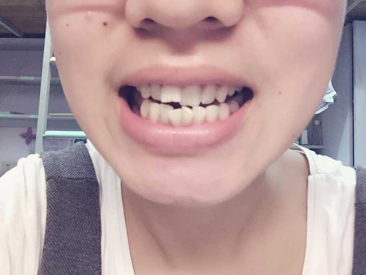 有没有人在广州光华口腔医院箍过牙?效果如何?收费高吗?