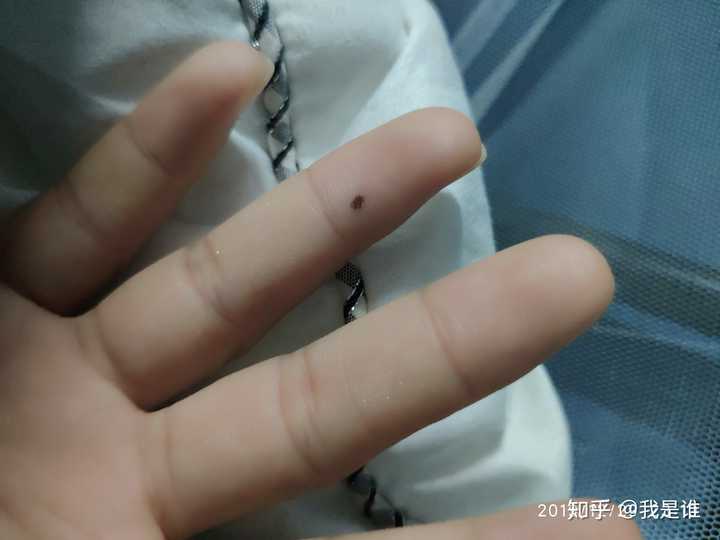 女生 右手无名指有痣?
