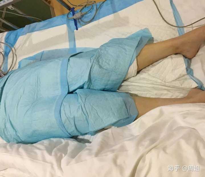 吸脂有哪些危害和后遗症?