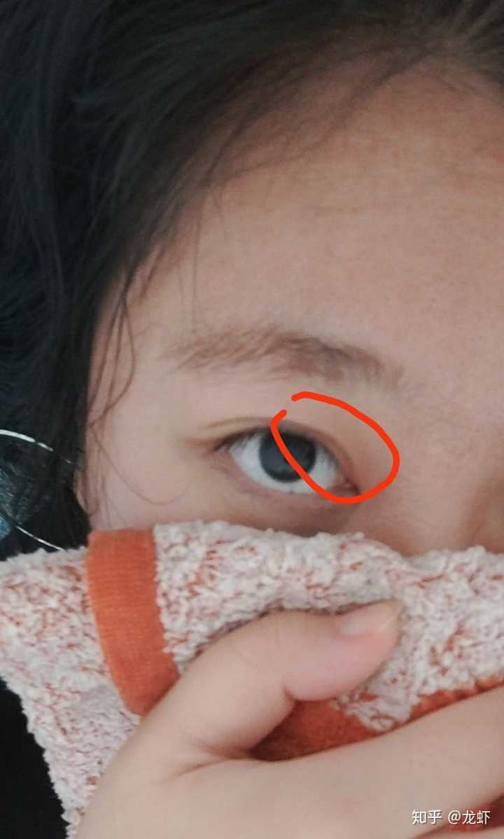 眼睛麦粒肿初期症状有哪些?