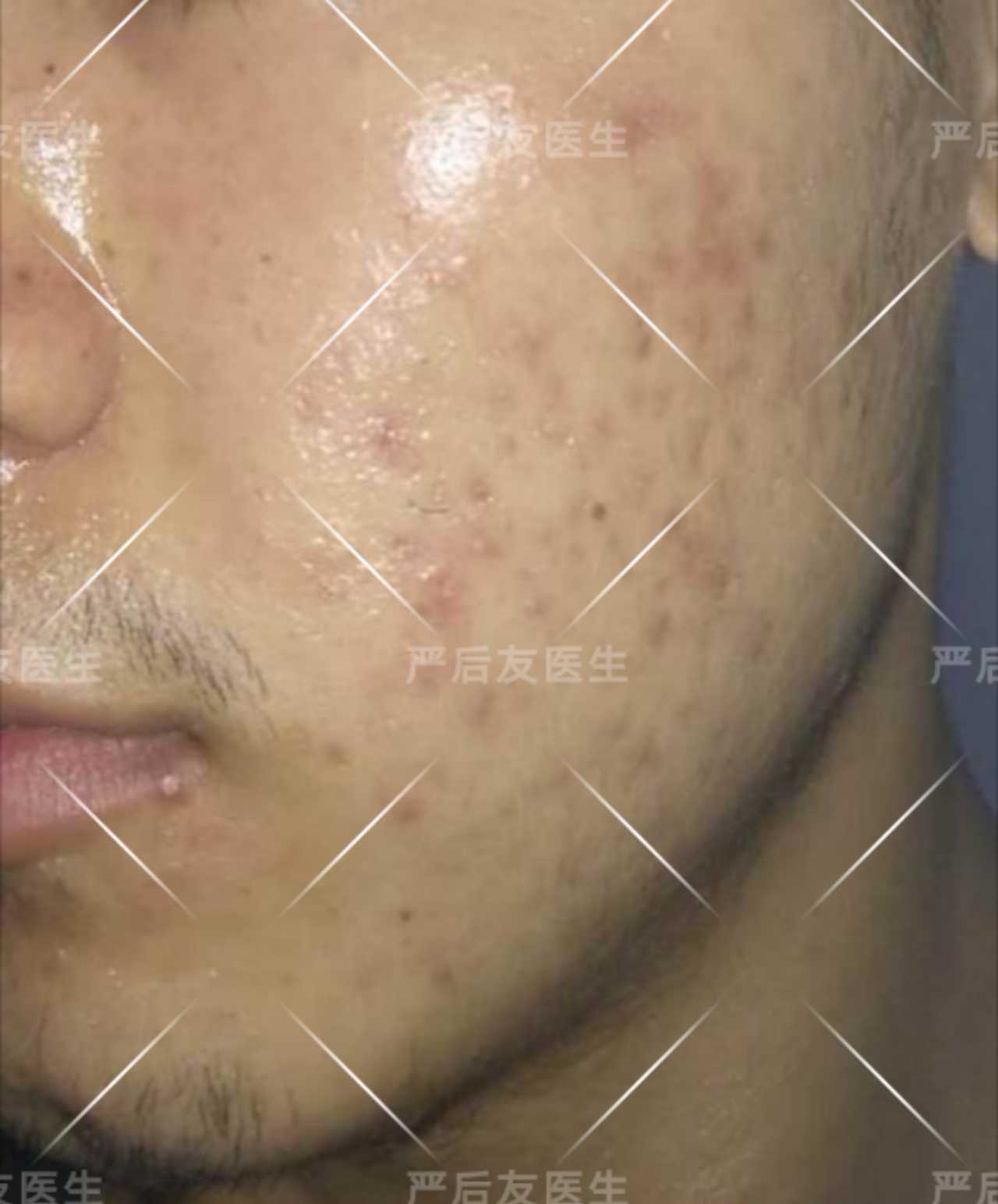 这个患者痘痘属于中度三级痤疮,给予四环素类抗生素口服8周,外用克林
