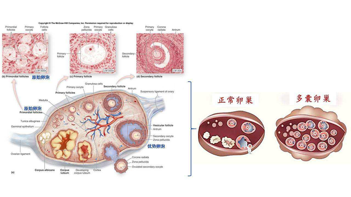 六出花 的想法 多囊卵巢综合征怎么回事?为何影响生育 知乎