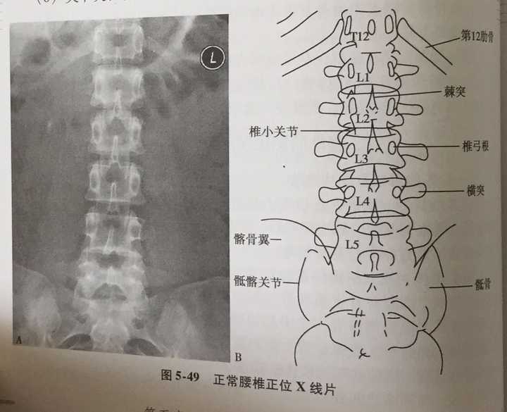 这是她给我的腰椎正侧位片,我再放2张正常腰椎正位片