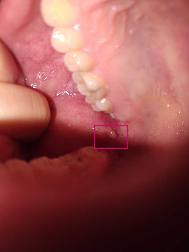粘液腺肿囊可以自愈吗?