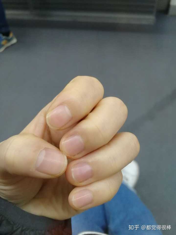 手指甲被咬的超级短怎么办?