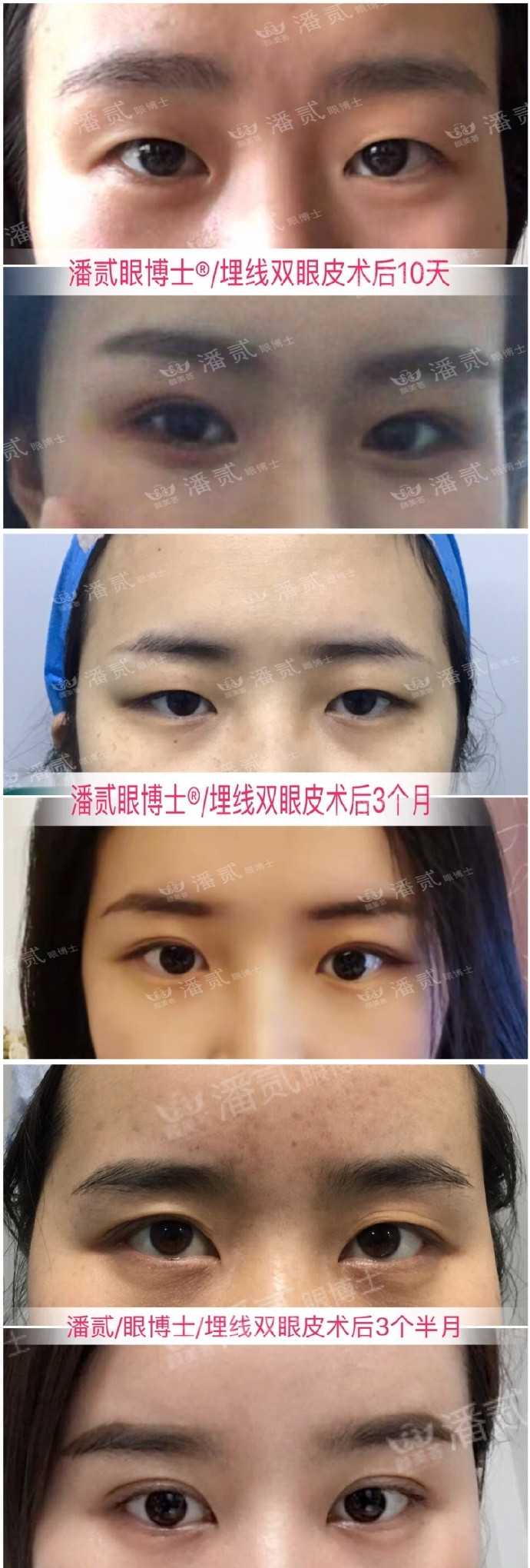 双眼皮是全割好还是埋线好?