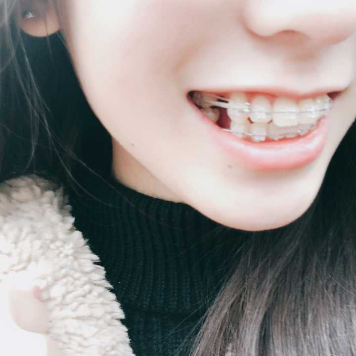 女生矫正牙齿是怎样一种体验