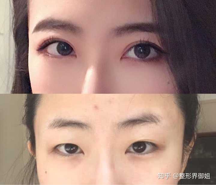 想去做双眼皮,就是不知道埋线双眼皮和割的双眼皮哪个好?有什么区别?