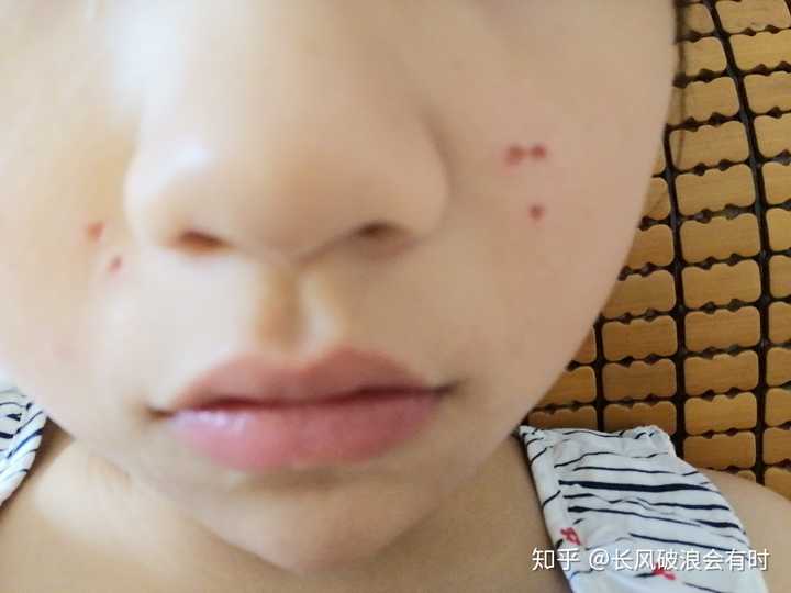 点痣选择何种方式好,有什么注意事项呢?