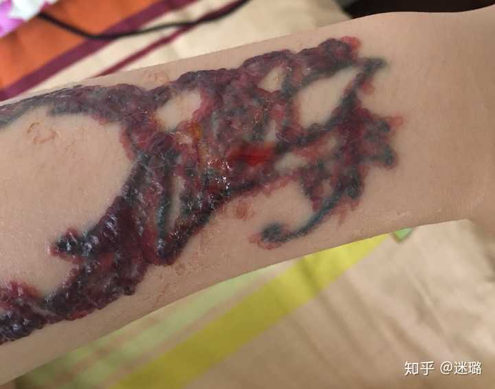 今天去的时候他说我这个变化的不明显 这一次皮秒打的力度比上次大了