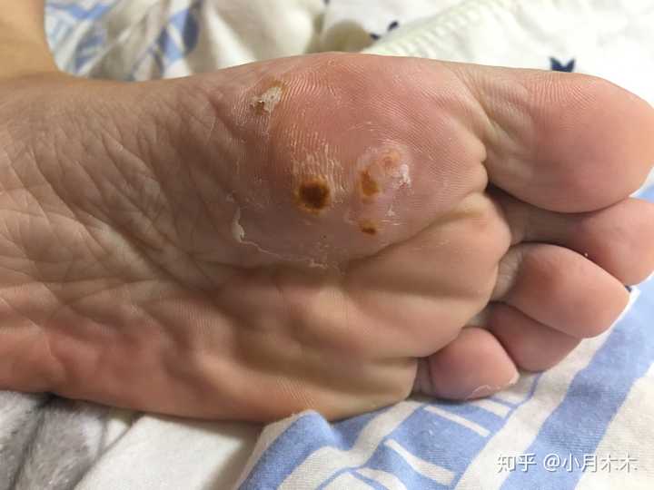 这是刚开始点药水两天左右,大鸡眼旁边还有三个小鸡眼,我都给点上了.