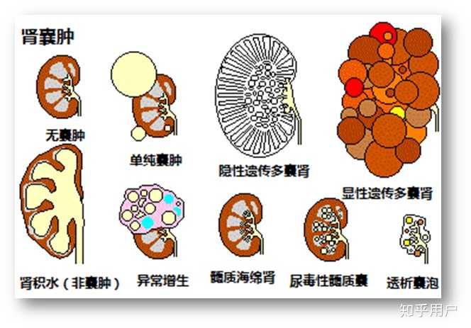 二,肾形态结构异常遗传病