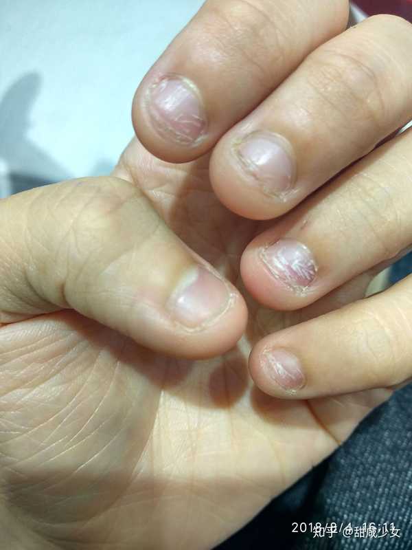 手指甲被咬的超级短怎么办