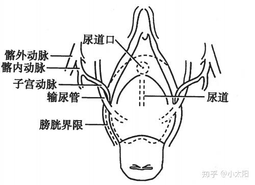 随脱垂子宫下移,膀胱输尿管下移,于尿道口形成"正三角区"