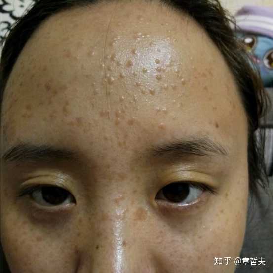 手指上长了一个扁平疣怎么办?