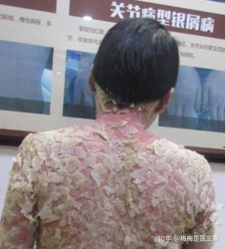 牛皮癣会掉头发不?