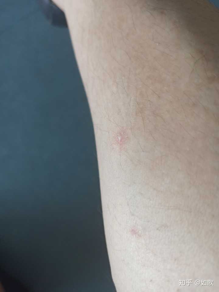 人感染了猫藓留下了疤怎么办?