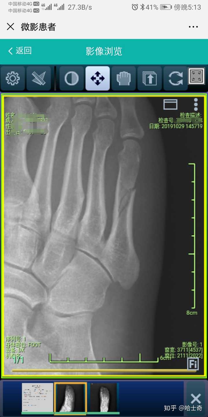 第五趾跖骨骨折多久可以走路?