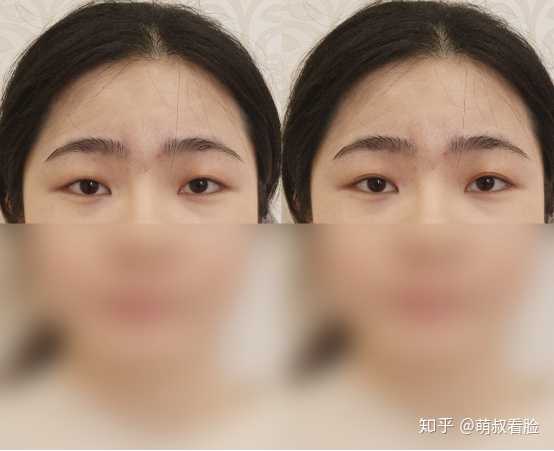 割双眼皮对外貌的改变大吗?