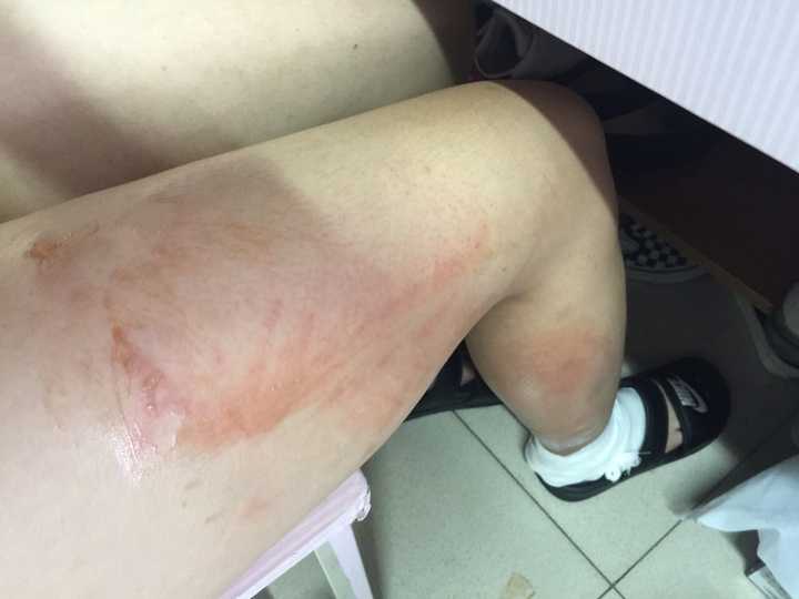 到了医务室冲了半小时水 ,医生给我包扎伤口.