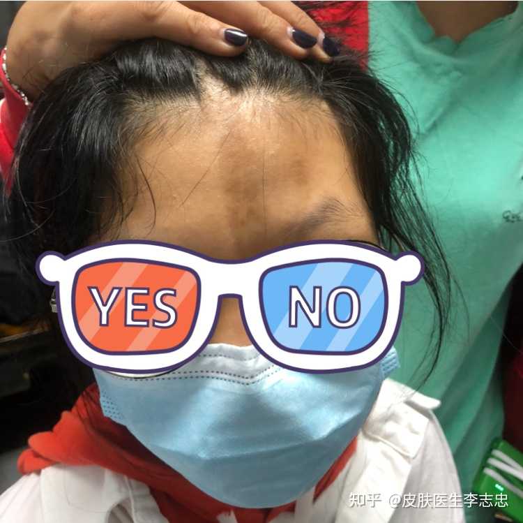 皮肤医生李志忠 的想法: 小姑娘是局限性硬皮病,这是