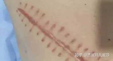 普通刀伤愈合的样子