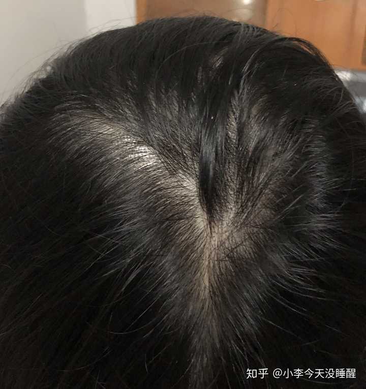 女生头顶头发少是什么体验 ?