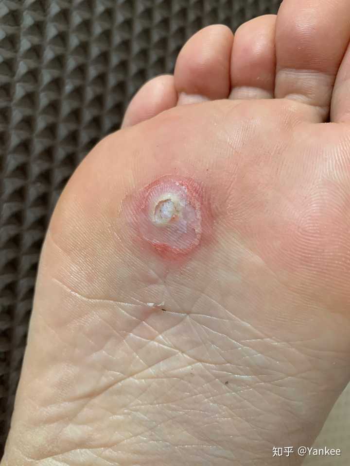 鸡眼怎么彻底挖出?