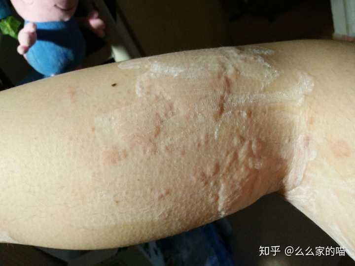 得了荨麻疹是一种怎样的体验?