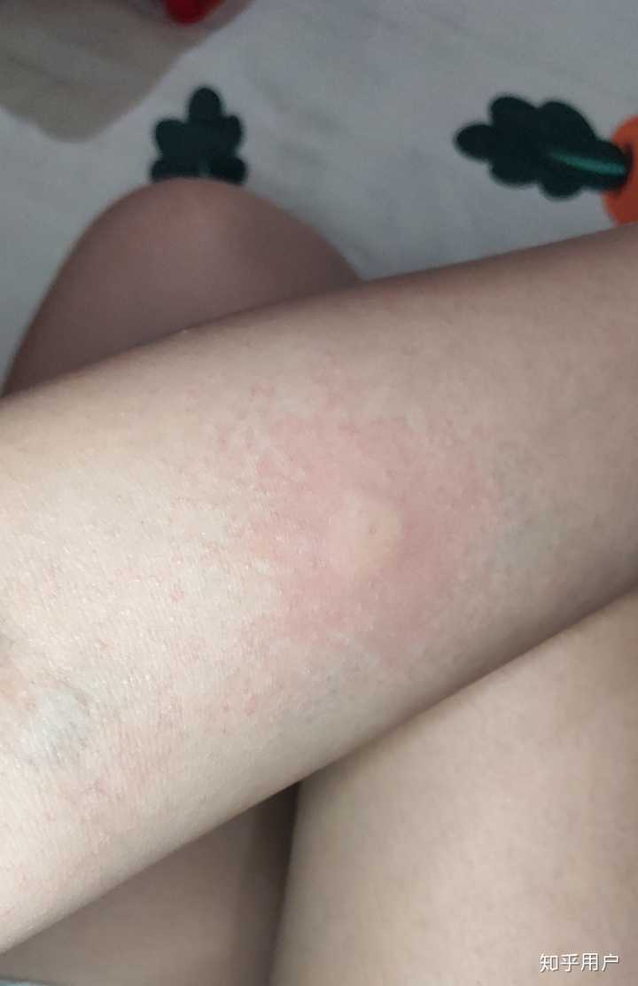 被蚊子咬的包第二天都肿的特别大怎办?