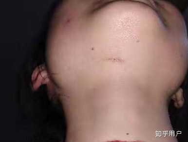 趁考完研比较悠闲就回家处理掉了,其实也没那么影响生活,就是在下巴