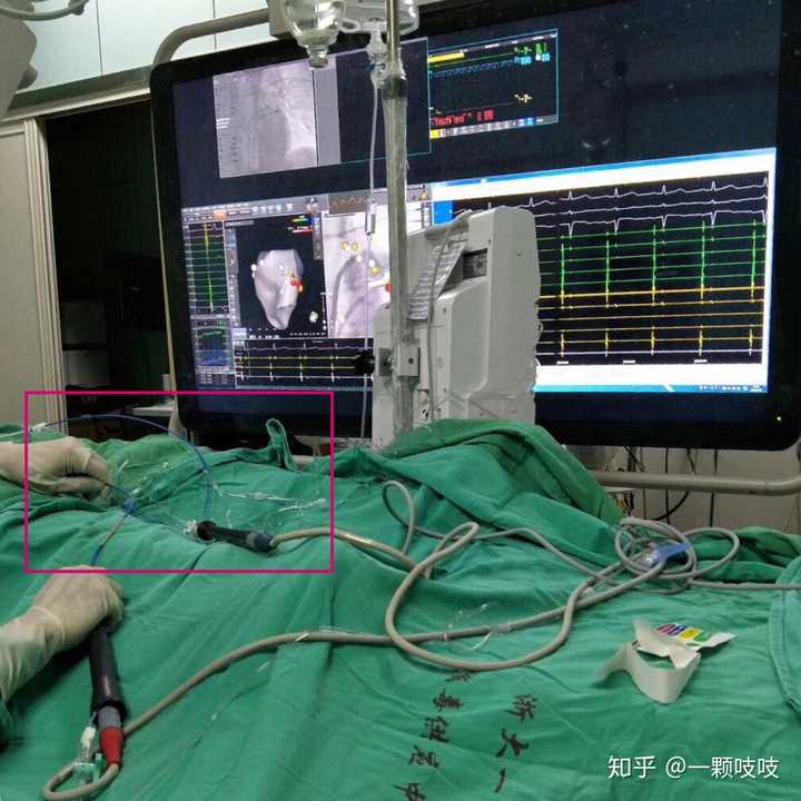 做射频消融手术是一种什么感受?