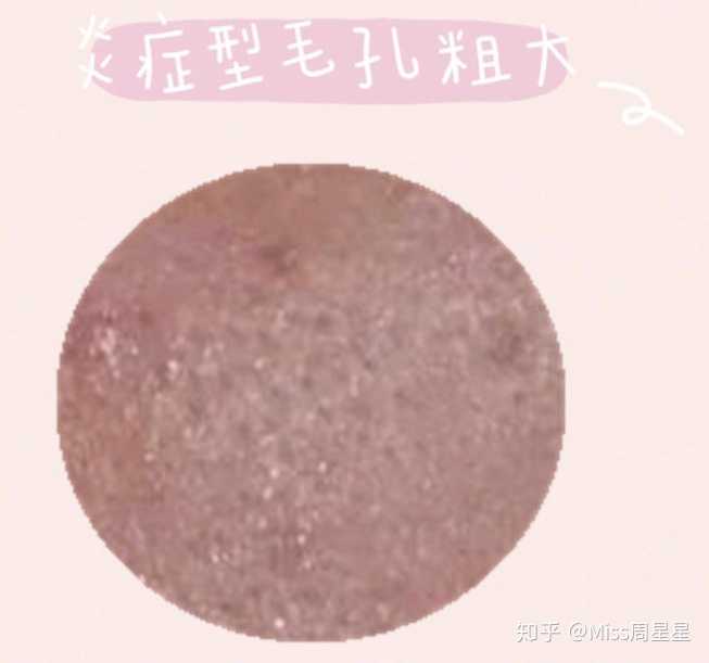 常随脂溢性皮炎,皮疹出现,红肿起皮
